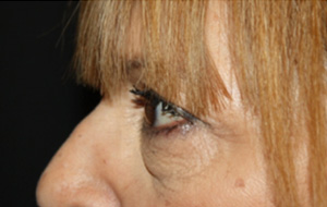 Blepharoplasty Before & After Patient #25176