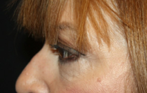 Blepharoplasty Before & After Patient #25176