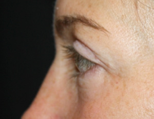 Blepharoplasty Before & After Patient #25194