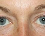 Blepharoplasty Before & After Patient #25194