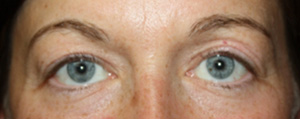 Blepharoplasty Before & After Patient #25194