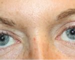 Blepharoplasty Before & After Patient #25194