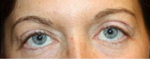 Blepharoplasty Before & After Patient #25194