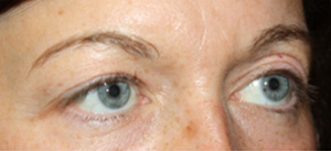 Blepharoplasty Before & After Patient #25194