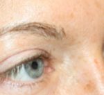 Blepharoplasty Before & After Patient #25194