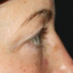 Blepharoplasty Before & After Patient #25194