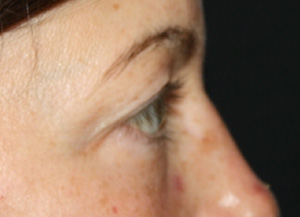 Blepharoplasty Before & After Patient #25194