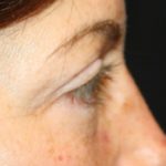 Blepharoplasty Before & After Patient #25194