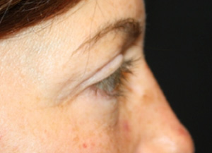 Blepharoplasty Before & After Patient #25194