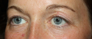 Blepharoplasty Before & After Patient #25194