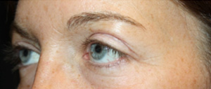 Blepharoplasty Before & After Patient #25194