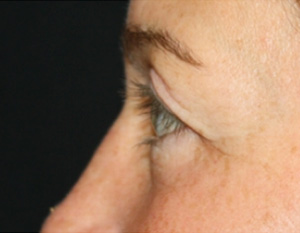 Blepharoplasty Before & After Patient #25194