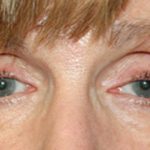 Blepharoplasty Before & After Patient #25195