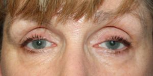 Blepharoplasty Before & After Patient #25195