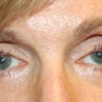 Blepharoplasty Before & After Patient #25195