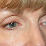 Blepharoplasty Before & After Patient #25195