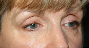 Blepharoplasty Before & After Patient #25195