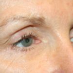 Blepharoplasty Before & After Patient #25195