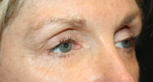 Blepharoplasty Before & After Patient #25195