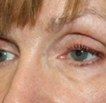 Blepharoplasty Before & After Patient #25195