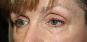 Blepharoplasty Before & After Patient #25195