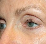 Blepharoplasty Before & After Patient #25195