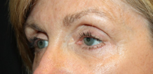 Blepharoplasty Before & After Patient #25195