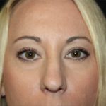 Blepharoplasty Before & After Patient #25212