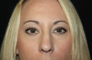 Blepharoplasty Before & After Patient #25212