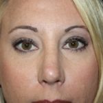 Blepharoplasty Before & After Patient #25212