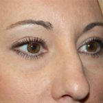 Blepharoplasty Before & After Patient #25212