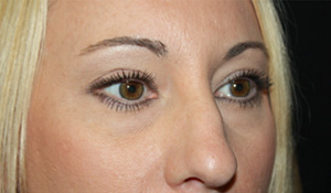 Blepharoplasty Before & After Patient #25212