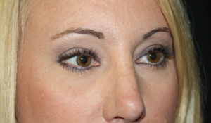 Blepharoplasty Before & After Patient #25212