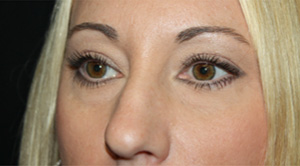 Blepharoplasty Before & After Patient #25212