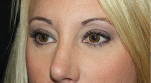 Blepharoplasty Before & After Patient #25212