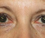 Blepharoplasty Before & After Patient #25213