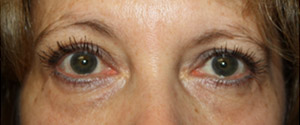 Blepharoplasty Before & After Patient #25213