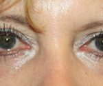 Blepharoplasty Before & After Patient #25213