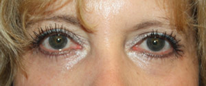Blepharoplasty Before & After Patient #25213