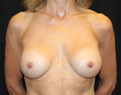 Breast Implant Exchange Before & After Patient #20657