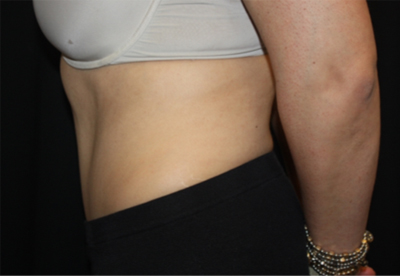 Tummy Tuck Before & After Patient #22706