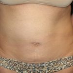 Tummy Tuck Before & After Patient #22706