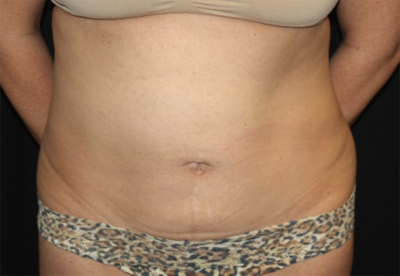 Tummy Tuck Before & After Patient #22706