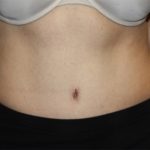 Tummy Tuck Before & After Patient #22706