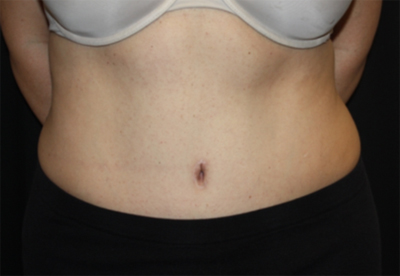 Tummy Tuck Before & After Patient #22706