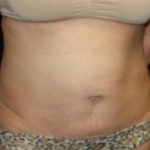 Tummy Tuck Before & After Patient #22706