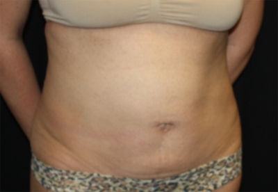 Tummy Tuck Before & After Patient #22706