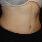 Tummy Tuck Before & After Patient #22706