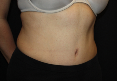 Tummy Tuck Before & After Patient #22706