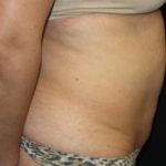 Tummy Tuck Before & After Patient #22706